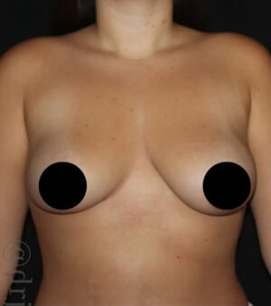 Breast Implants with Lift Before and After Gallery
