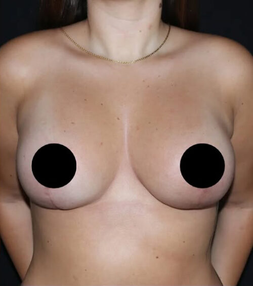 Breast Implants with Lift Before and After Gallery