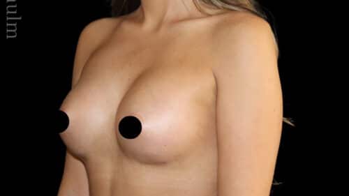 Breast Augmentation Before and After Gallery