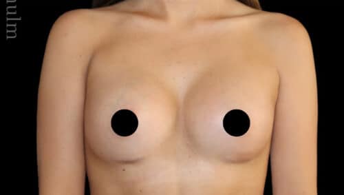Breast Augmentation Before and After Gallery