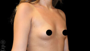 Breast Augmentation Before and After Gallery