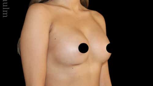 Breast Augmentation Before and After Gallery