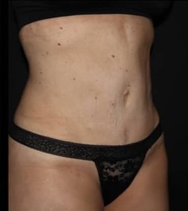 Tummy Tuck Before and After Gallery