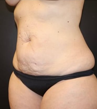Tummy Tuck Before and After Gallery