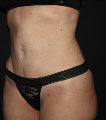 Tummy Tuck Before and After Gallery