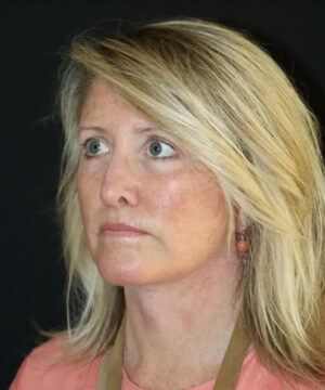 Face and Necklift Before and After Gallery