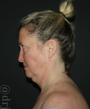 Face and Necklift Before and After Gallery