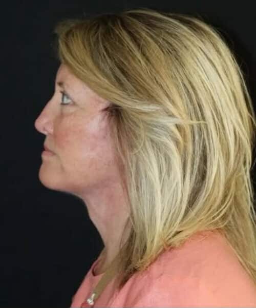 Face and Necklift Before and After Gallery