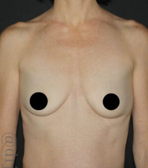 Breast Augmentation Before and After Gallery