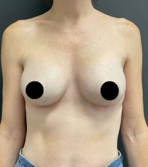 Breast Augmentation Before and After Gallery