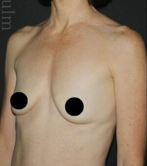 Breast Augmentation Before and After Gallery
