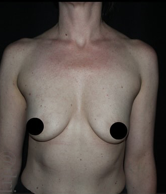 Breast Implants with Lift Before and After Gallery
