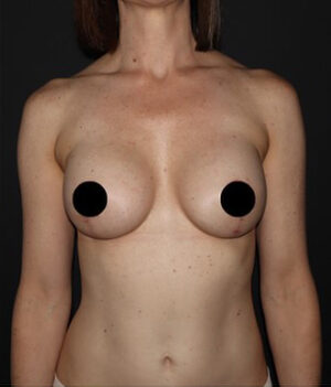 Breast Implants with Lift Before and After Gallery