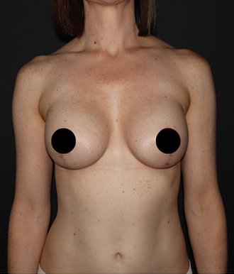 Breast Implants with Lift Before and After Gallery