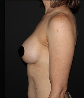 Breast Implants with Lift Before and After Gallery