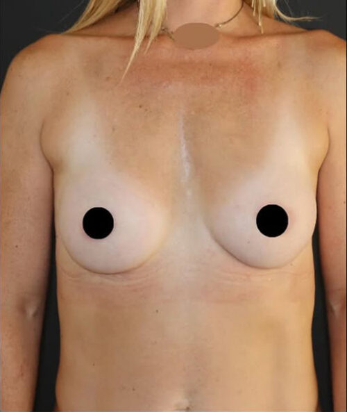 Breast Augmentation Before and After Gallery