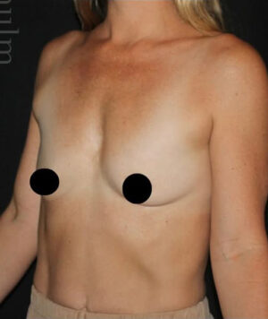 Breast Augmentation Before and After Gallery