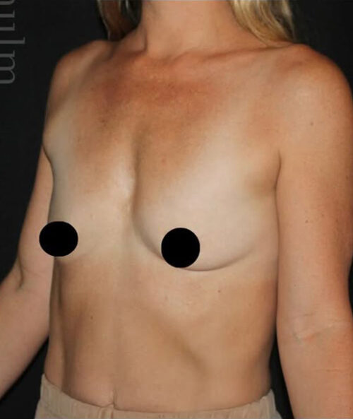 Breast Augmentation Before and After Gallery