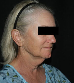 Face and Necklift Before and After Gallery