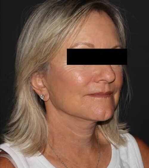 Face and Necklift Before and After Gallery