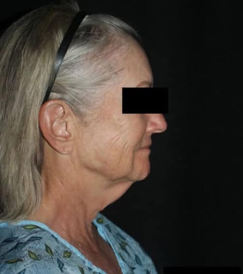 Face and Necklift Before and After Gallery