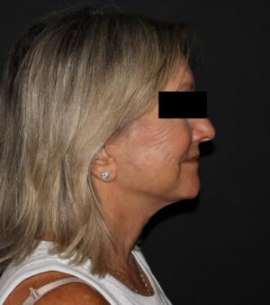 Face and Necklift Before and After Gallery