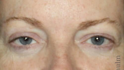 Eyelid Surgery Before and After Gallery