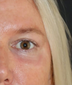 Eyelid Surgery Before and After Gallery