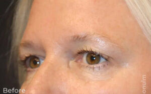 Eyelid Surgery Before and After Gallery