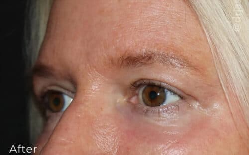 Eyelid Surgery Before and After Gallery