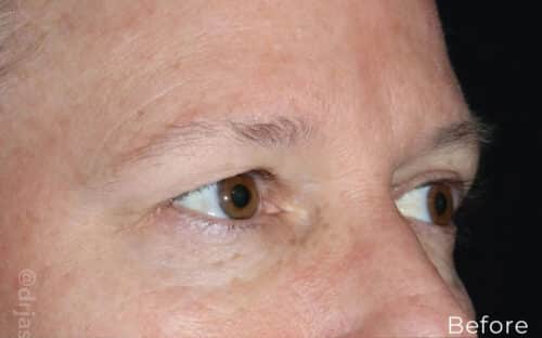 Eyelid Surgery Before and After Gallery