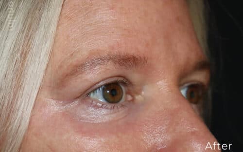 Eyelid Surgery Before and After Gallery