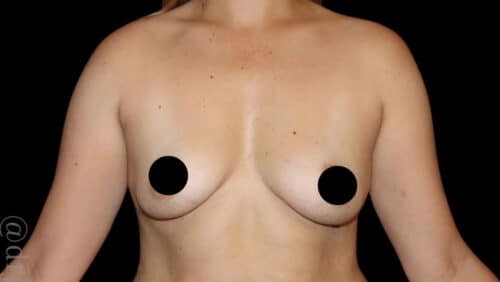 Breast Augmentation Before and After Gallery