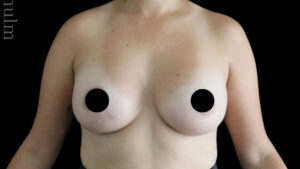 Breast Augmentation Before and After Gallery