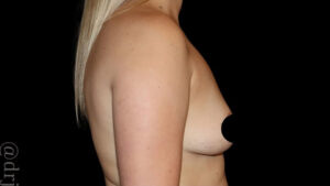 Breast Augmentation Before and After Gallery