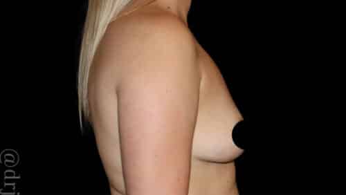 Breast Augmentation Before and After Gallery