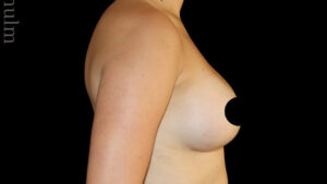 Breast Augmentation Before and After Gallery