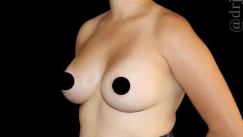 Breast Augmentation Before and After Gallery