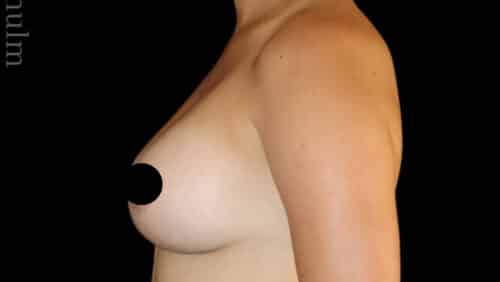 Breast Augmentation Before and After Gallery