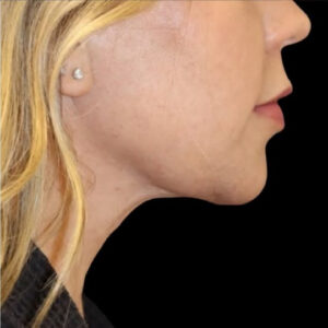 Submental Liposuction Before and After Gallery