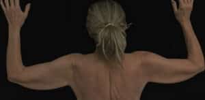 Arm Lift Before and After Gallery