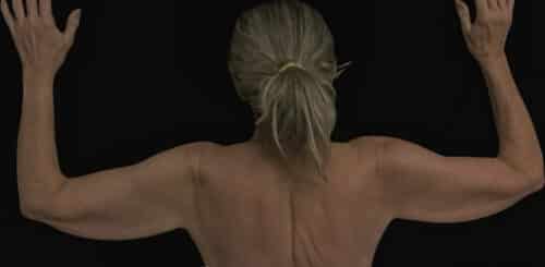 Arm Lift Before and After Gallery