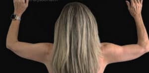 Arm Lift Before and After Gallery