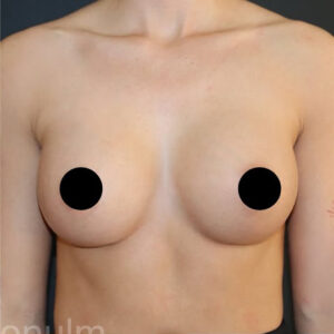 Breast Augmentation Before and After Gallery