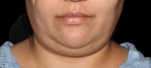 Submental Liposuction Before and After Gallery