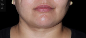 Submental Liposuction Before and After Gallery