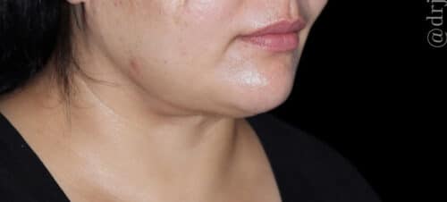 Submental Liposuction Before and After Gallery