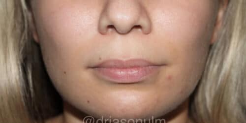Lip lift Before and After Gallery