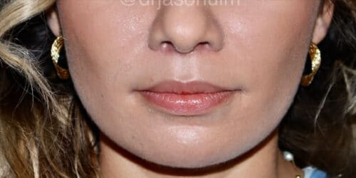 Lip lift Before and After Gallery
