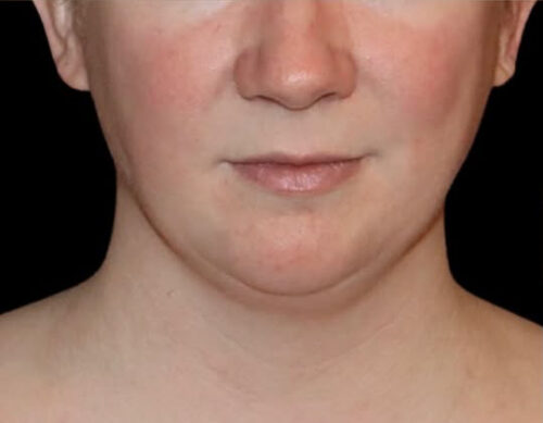 Submental Liposuction Before and After Gallery